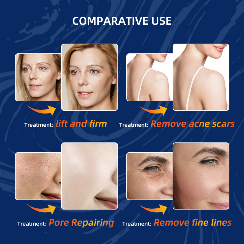 1927nm Thulium Laser Machine Skin Resurfacing Pigmentation Removal Beauty Equipment