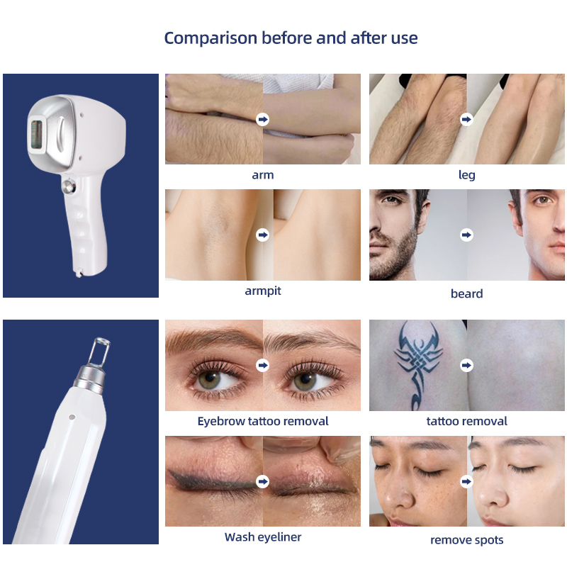 Four Wavelength Diode Laser Hair Removal Machine 755/808/940/1064nm Professional Ice Cooling System