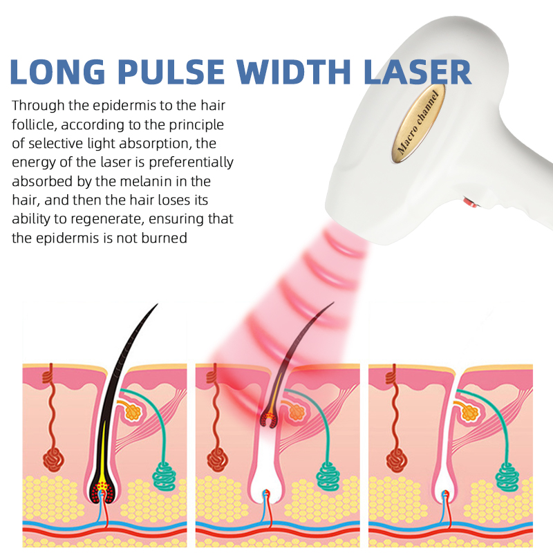 808nm Diode Laser Hair Removal Machine Professional Permanent Hair Removal Device