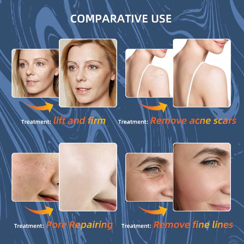 10600nm CO2 Fractional Laser Machine Multimode Skin Resurfacing Gynecology Equipment